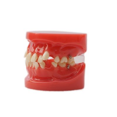 Model Pengajaran Gigi Dental Penggunaan Pelatihan Model Ortodontik Gigi Fungsional Tanpa Braket