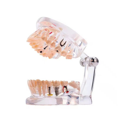 Model Gigi Penyakit Implan Satu Bulan Penuh 32 Gigi Desain Jelas Model Patologi Gigi